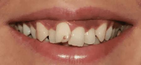 Veneers Before
